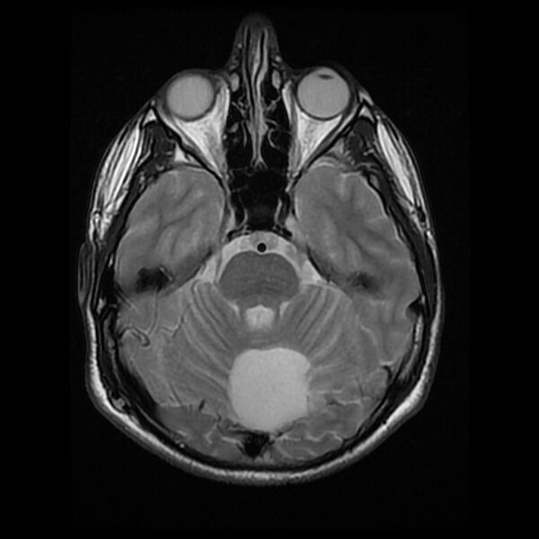 File:Chiasmatic-hypothalamic juvenile pilocytic astrocytoma (Radiopaedia 78533-91235 Axial T2 10).jpg