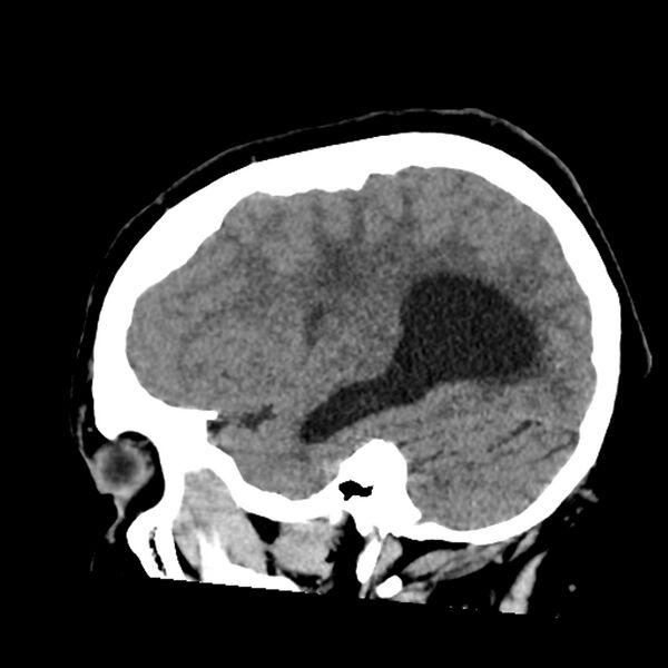 File:Chiasmatic-hypothalamic juvenile pilocytic astrocytoma (Radiopaedia 78533-91237 B 20).jpg