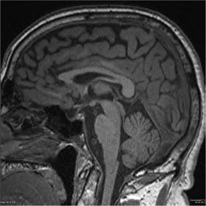 Chondrosarcoma of skull base- grade II (Radiopaedia 40948-43654 Sagittal T1 13).jpg
