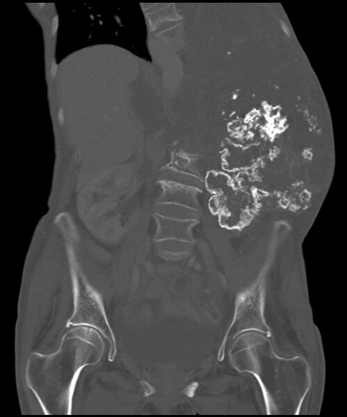 File:Chondrosarcoma of the spine (Radiopaedia 49871-55143 Coronal bone window 16).jpg