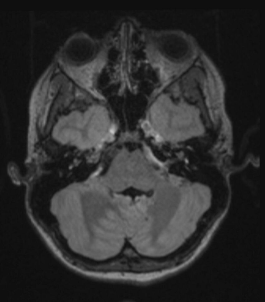 Choroid plexus carcinoma (Radiopaedia 91013-108553 Axial FLAIR C+ 93).jpg