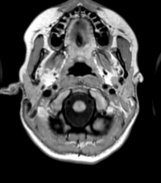 File:Choroid plexus carcinoma (Radiopaedia 91013-108553 Axial T1 28).jpg