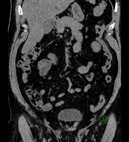 File:Chromophobe renal cell carcinoma (Radiopaedia 84286-99573 Coronal non-contrast 62).jpg
