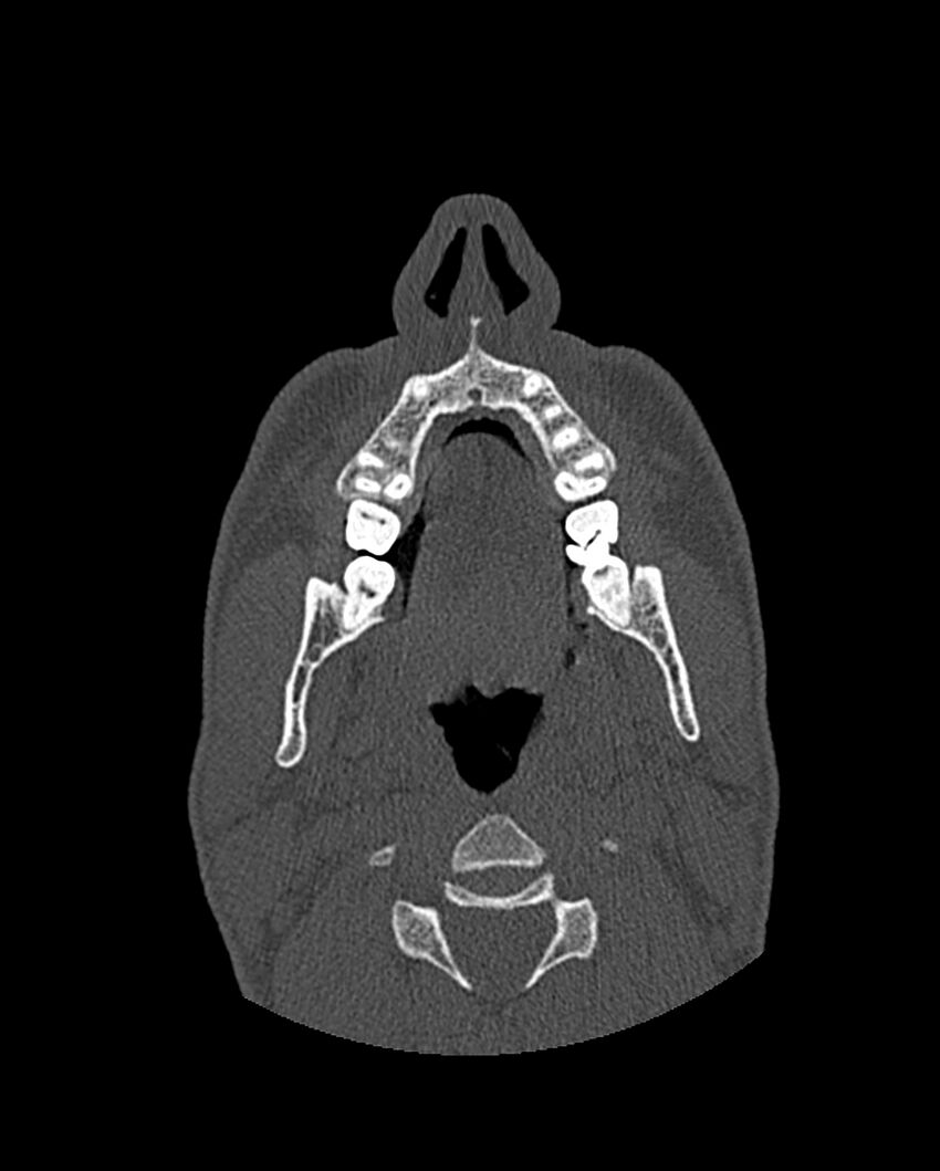 Chronic maxillary sinusitis caused by a foreign body (Radiopaedia 58521-65676 Axial bone window 21).jpg