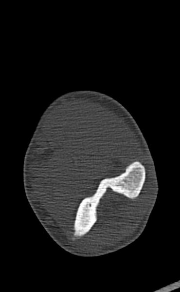 File:Chronic osteomyelitis of the distal humerus (Radiopaedia 78351-90971 Axial bone window 83).jpg