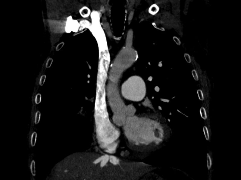 File:Chronic pulmonary embolism (Radiopaedia 91241-108843 A 41).jpg
