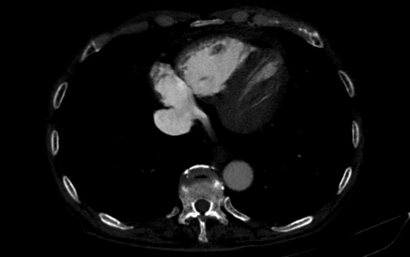 File:Chronic pulmonary embolism (Radiopaedia 91241-108843 B 144).jpg
