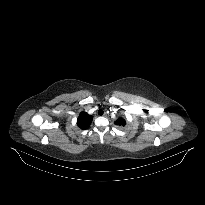 Chronic thromboembolic pulmonary hypertension (CTEPH) (Radiopaedia 74597-85532 Axial C+ CTPA 144).jpg