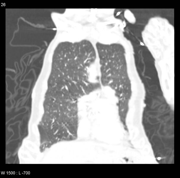 File:Clagett thoracotomy (Radiopaedia 8568-9403 Coronal lung window 26).jpg