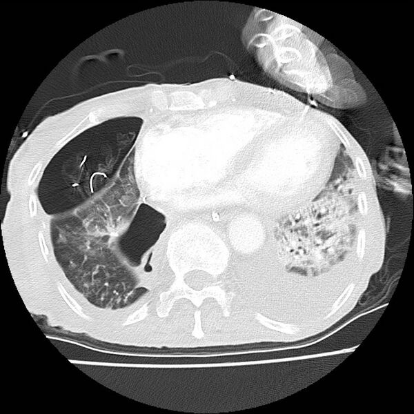 File:Clagett thoracotomy with bronchopleural fistula (Radiopaedia 29192-29587 Axial lung window 36).jpg