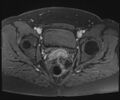 Class II Mullerian duct anomaly- unicornuate uterus with rudimentary horn and non-communicating cavity (Radiopaedia 39441-41755 Axial T1 fat sat 92).jpg