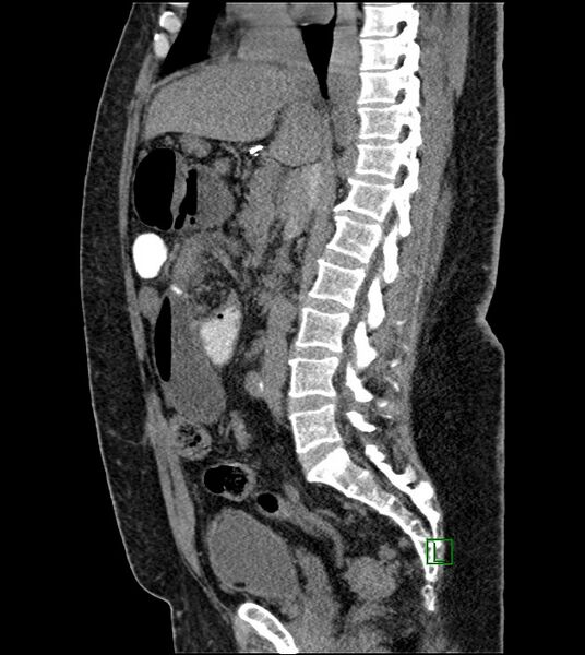 File:Closed-loop small bowel obstruction-internal hernia (Radiopaedia 78439-91096 C 80).jpg