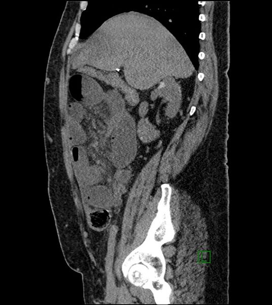 File:Closed-loop small bowel obstruction-internal hernia (Radiopaedia 78439-91096 C 99).jpg