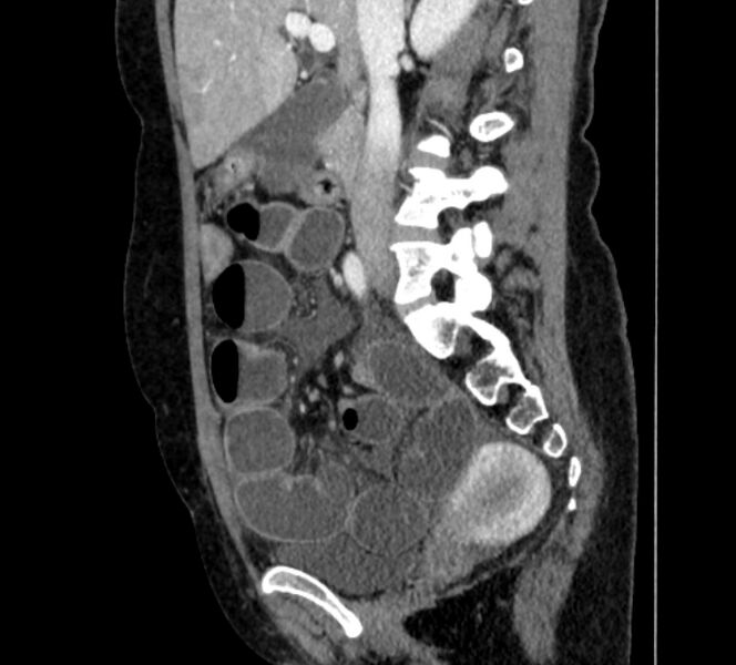 File:Closed loop small bowel obstruction (Radiopaedia 71211-81508 C 58).jpg