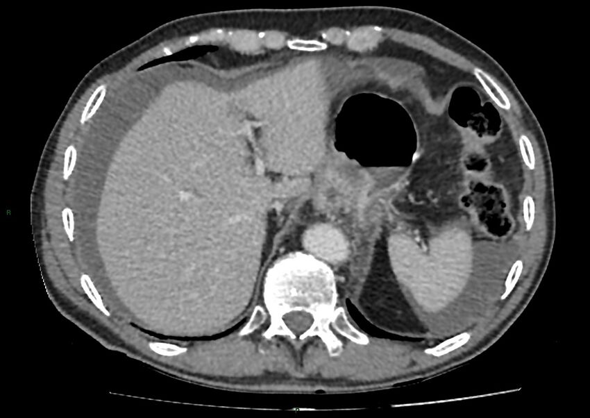 Closed loop small bowel obstruction with ischemia (Radiopaedia 84180-99456 A 20).jpg