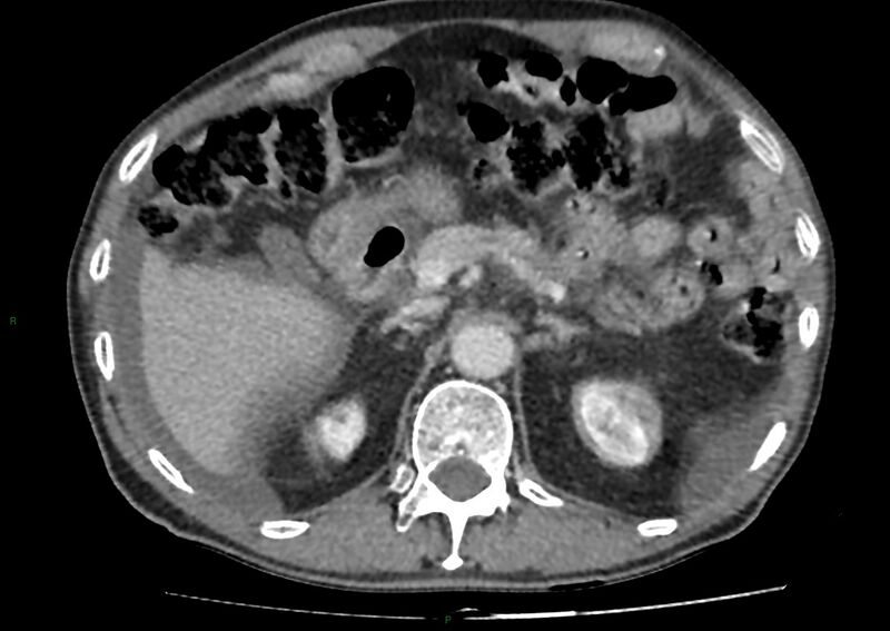 File:Closed loop small bowel obstruction with ischemia (Radiopaedia 84180-99456 A 33).jpg
