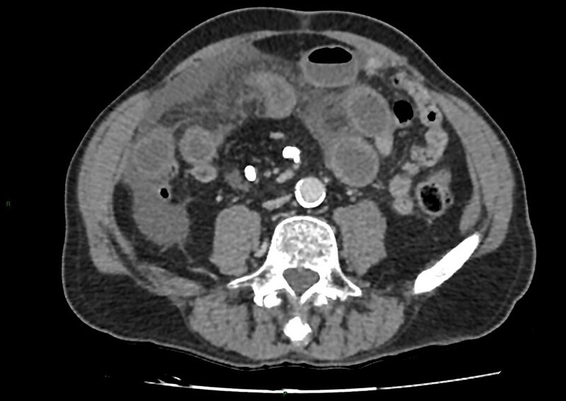 File:Closed loop small bowel obstruction with ischemia (Radiopaedia 84180-99456 A 69).jpg
