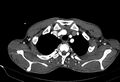 Coarctation of aorta with aortic valve stenosis (Radiopaedia 70463-80574 A 1).jpg