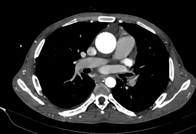 File:Coarctation of aorta with aortic valve stenosis (Radiopaedia 70463-80574 A 88).jpg