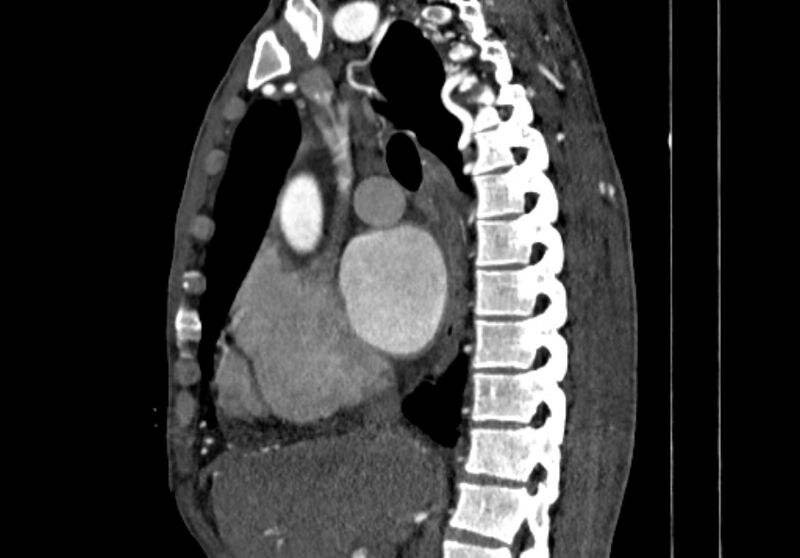 File:Coarctation of aorta with aortic valve stenosis (Radiopaedia 70463-80574 B 35).jpg