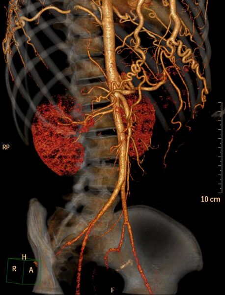 File:Coarctation of the aorta (Radiopaedia 27458-27657 3D 12).jpg