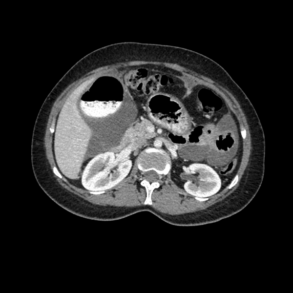 File:Cocoon abdomen with possible tubo-ovarian abscess (Radiopaedia 46235-50636 A 15).png