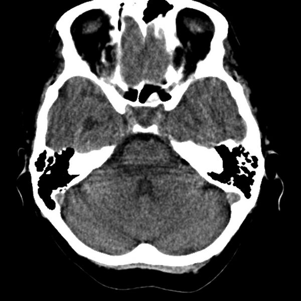 File:Colloid cyst with hydrocephalus (Radiopaedia 9373-10064 Axial non-contrast 6).jpg