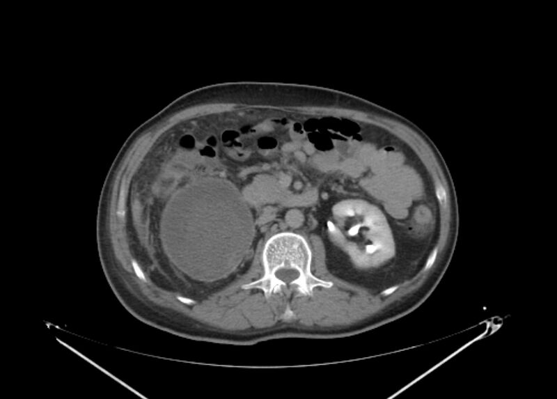 File:Colon cancer mimicking renal cell carcinoma (Radiopaedia 28986-29335 Axial C+ delayed 32).jpg