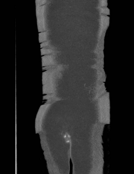 File:Colonic pseudo-obstruction (Radiopaedia 79752-92980 B 58).png