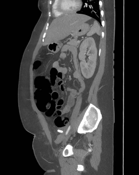 File:Colonic pseudo-obstruction (Radiopaedia 79752-92980 C 52).png