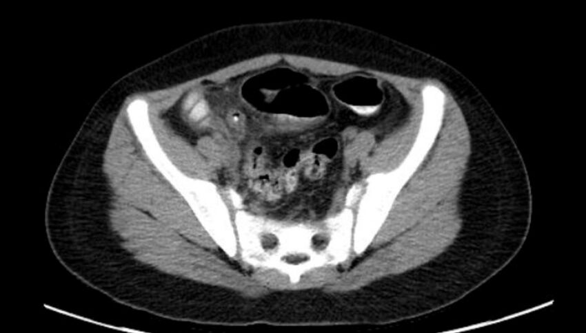 Figure 10.8A Axial CT of an Adult Abdomen demonstrating a thick-walled appendix with a calcified appendicolith.jpg