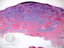 Lymphomatoid papulosis/pathology