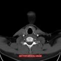 Nasopharyngeal carcinoma recurrence - skull base destruction (Radiopaedia 29107-29491 A 29).jpg