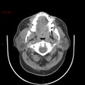 Nasopharyngeal lymphoma (Radiopaedia 54235-60433 A 20).jpg