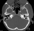 Necrotizing otitis externa (Radiopaedia 19938-19971 Axial bone window 4).jpg
