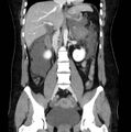Necrotizing pancreatitis (Radiopaedia 23001-23031 B 37).jpg