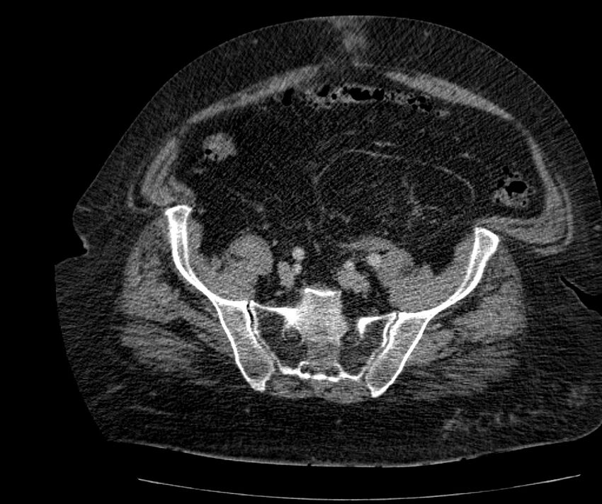 Nephroptosis with inguinal hernia containing perirenal fat (Radiopaedia 56632-63391 C 262).jpg