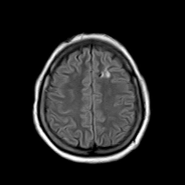 File:Neurofibromatosis type 2 (Radiopaedia 67470-76871 Axial FLAIR 18).jpg