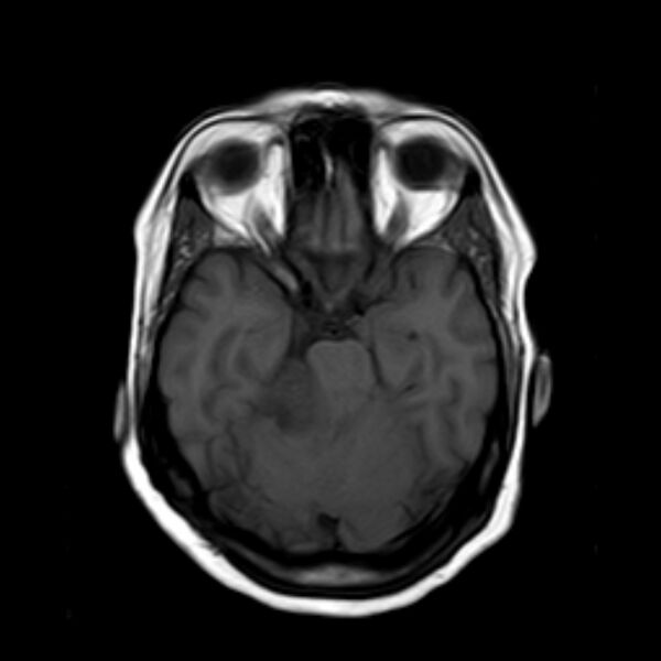 File:Neurofibromatosis type 2 (Radiopaedia 67470-76871 Axial T1 8).jpg