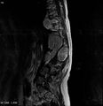 Neurofibromatosis type 2 - cranial and spinal involvement (Radiopaedia 5351-7112 B 14).jpg