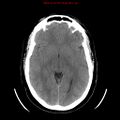 Neuroglial cyst (Radiopaedia 10713-11185 Axial non-contrast 18).jpg