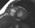 Non-compaction of the left ventricle (Radiopaedia 69436-79314 Short axis cine 104).jpg