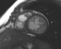 Non-compaction of the left ventricle (Radiopaedia 69436-79314 Short axis cine 117).jpg