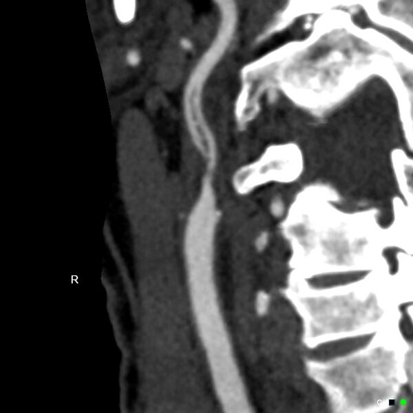 File:Non-occlusive intraluminal internal carotid artery thrombus (Radiopaedia 37751-39658 A 69).jpg