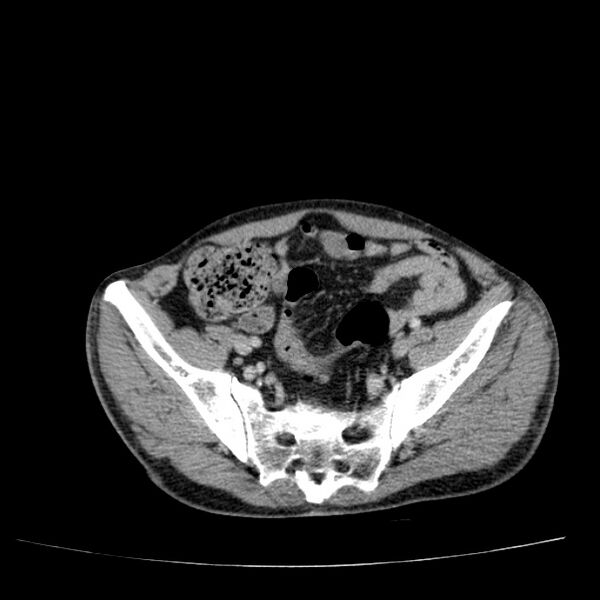 File:Non small-cell lung cancer (Radiopaedia 24467-24769 C+ delayed 102).jpg