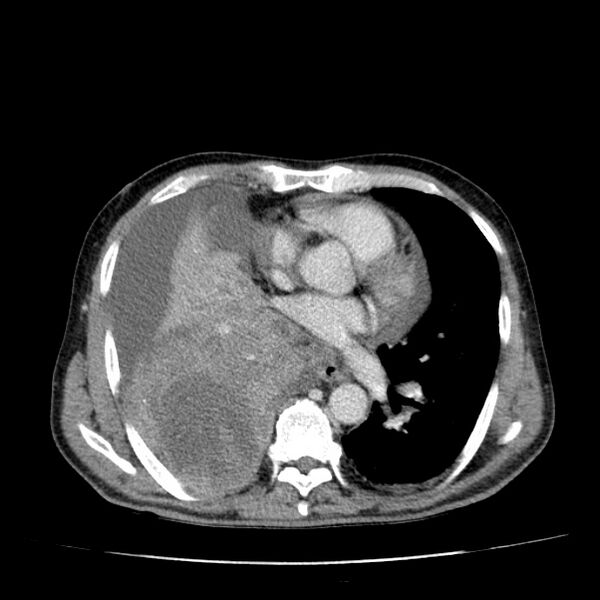 File:Non small-cell lung cancer (Radiopaedia 24467-24769 C+ delayed 35).jpg