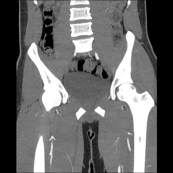 File:Normal CT angiogram of pelvis (Radiopaedia 45390-49430 B 24).jpg