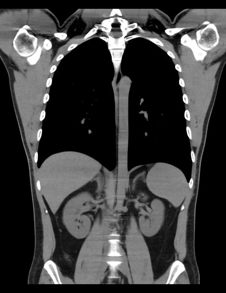 File:Normal CT virtual gastroscopy (Radiopaedia 29960-30501 E 1).jpg