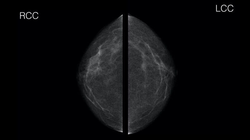 File:Normal breast mammography (tomosynthesis) and ultrasound (Radiopaedia 65325-102031 CC 1).jpeg