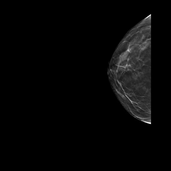 File:Normal breast mammography (tomosynthesis) and ultrasound (Radiopaedia 65325-74353 RCC Tomo 36).jpeg